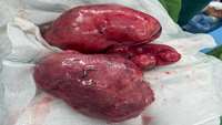 دکتر صفاریه متخصص زنان فلوشیپ آنکولوژی و انجام عمل میومکتومی